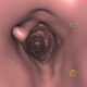Wegener's granulomatosis of trachea, virtual endoscopy: CT - Computed tomography